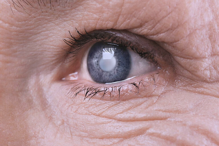 Imagem cirurgia de-catarata
