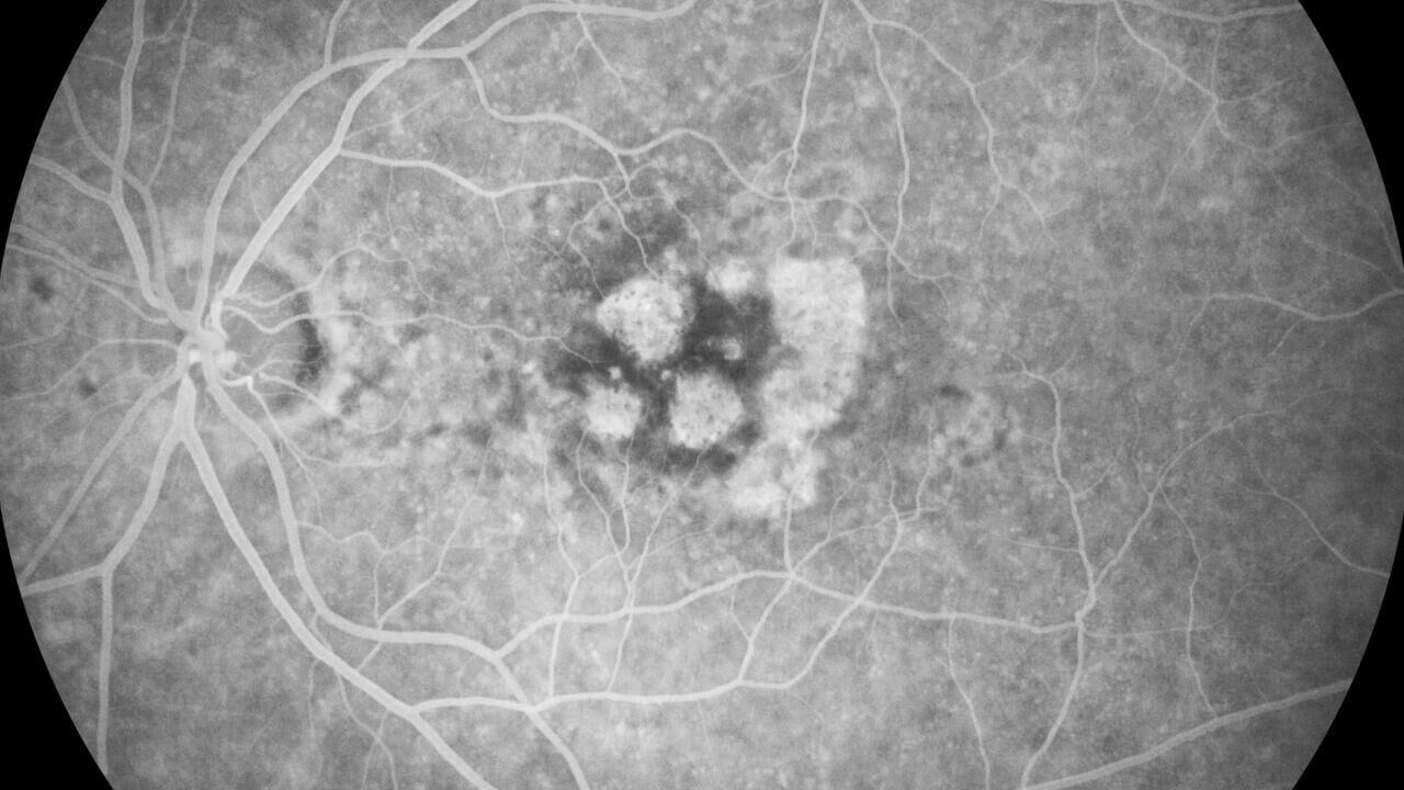 Imagem angiografia fluoresceína