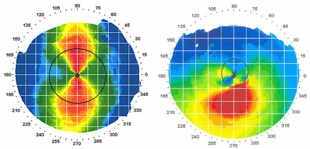 Imagem topografia da-cornea