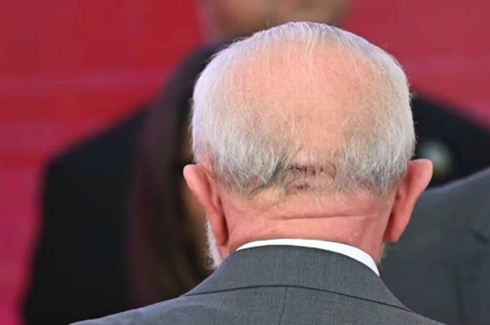 Imagem de compartilhamento para o artigo Presidente Lula será submetido a novo procedimento médico nesta quinta-feira da MS Todo dia