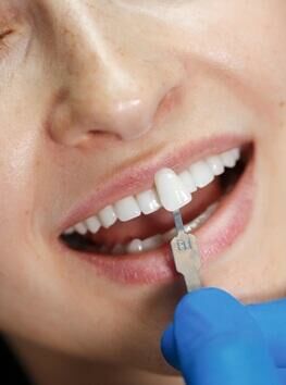 Estética Dental com facetas em resina e porcelana