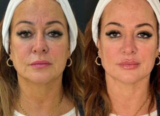 Imagem da notícia Nadine Gonçalves, mãe de Neymar, investe fortuna em procedimento facial e mudança impressiona a web
