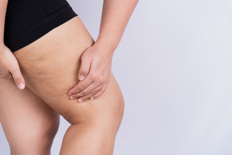 Imagem lipedema-tudo-o-que-voce-precisa-saber%20-%202