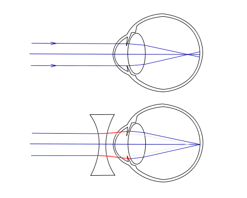 Erros Refracionais