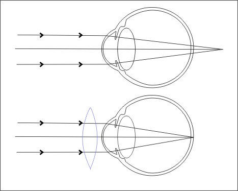 Erros Refracionais