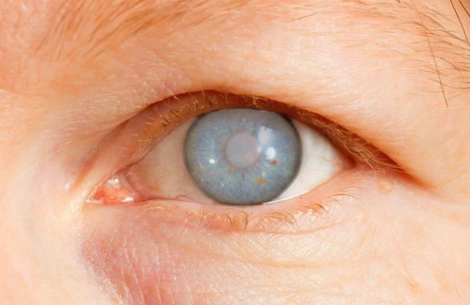 Imagem Glaucoma