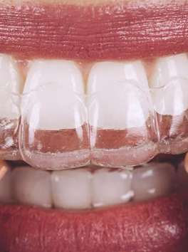 Alinhadores Invisíveis