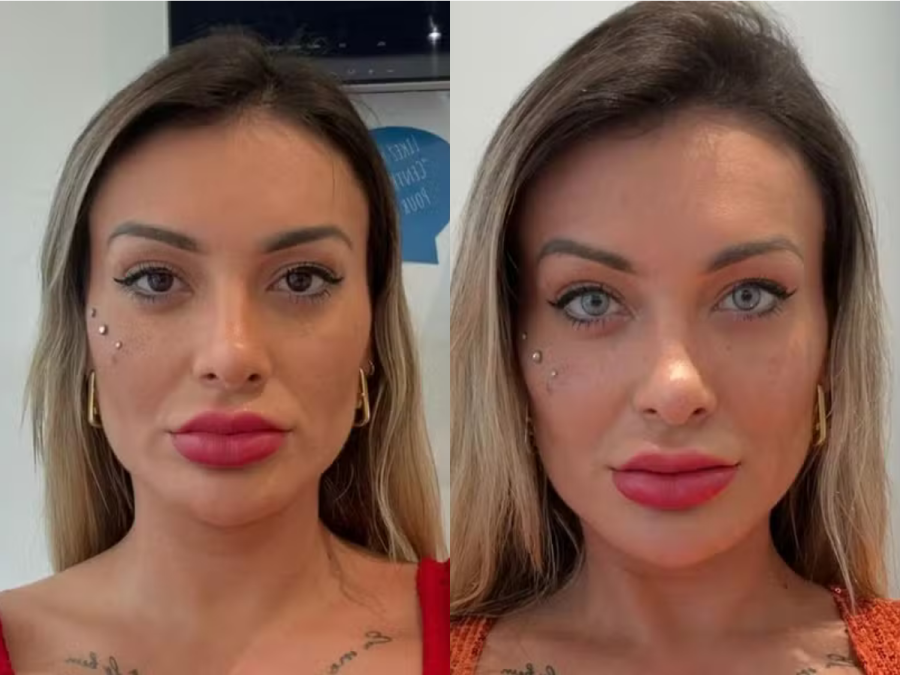 Imagem antes-e-depois-mudanca-olhos-andressa-urach