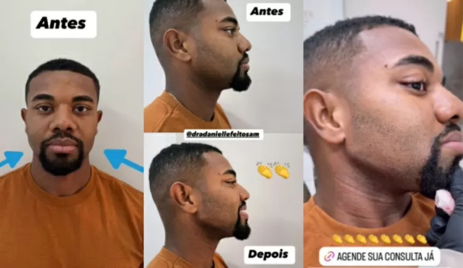 Imagem antes-depois-harmonizacao-davi-brito