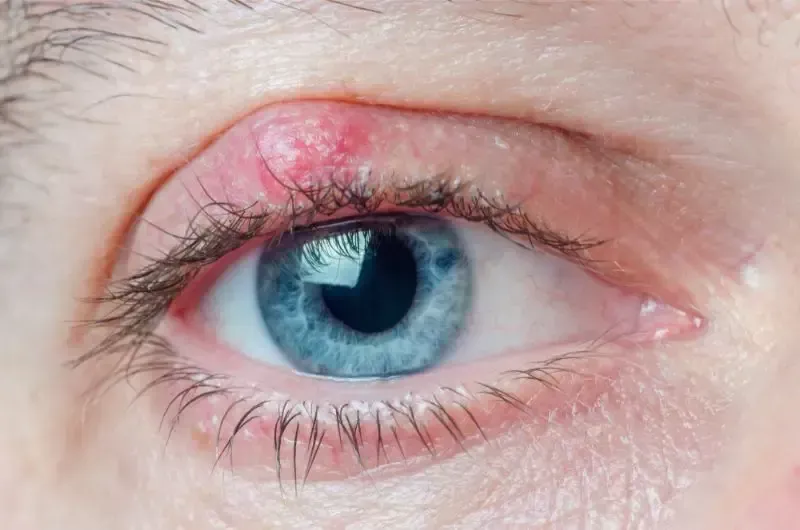 Imagem cirurgia de-calazio